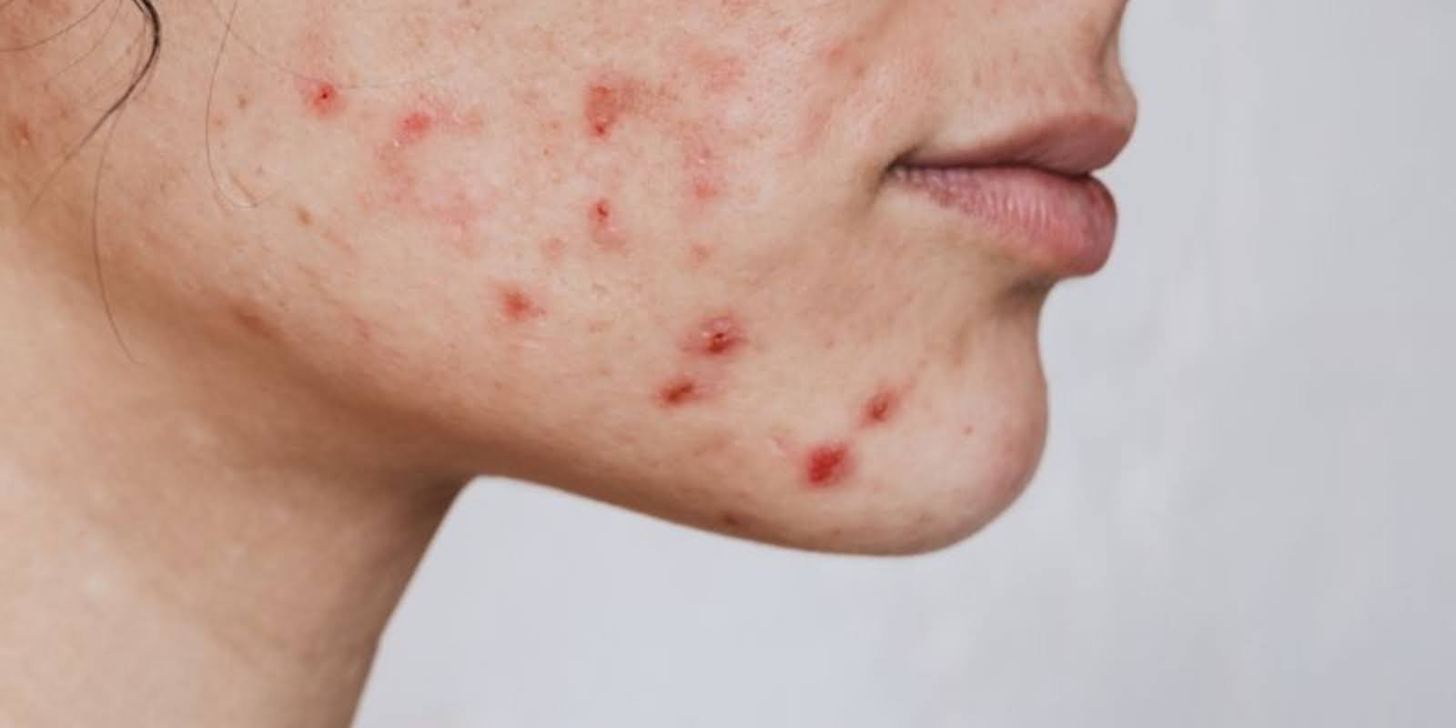 Hormonal Acne in Adults: Natural Treatments That Target the Root Cause